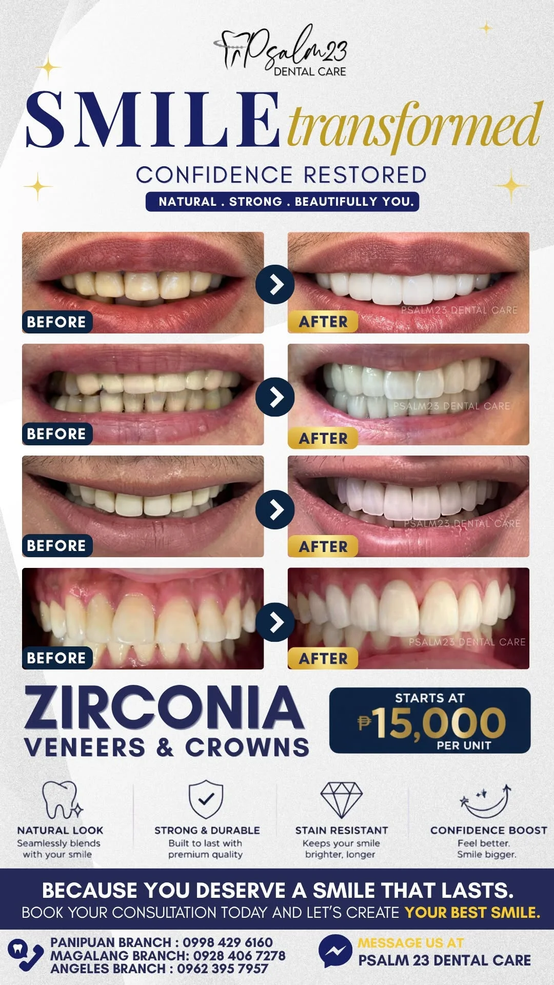 Zirconia Veneers and Crowns